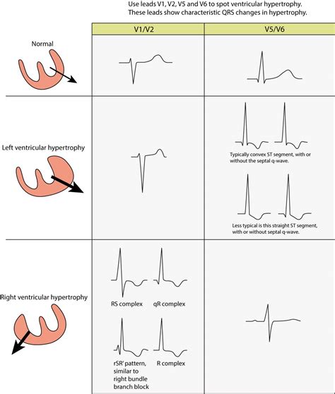 lvh ecg meaning.